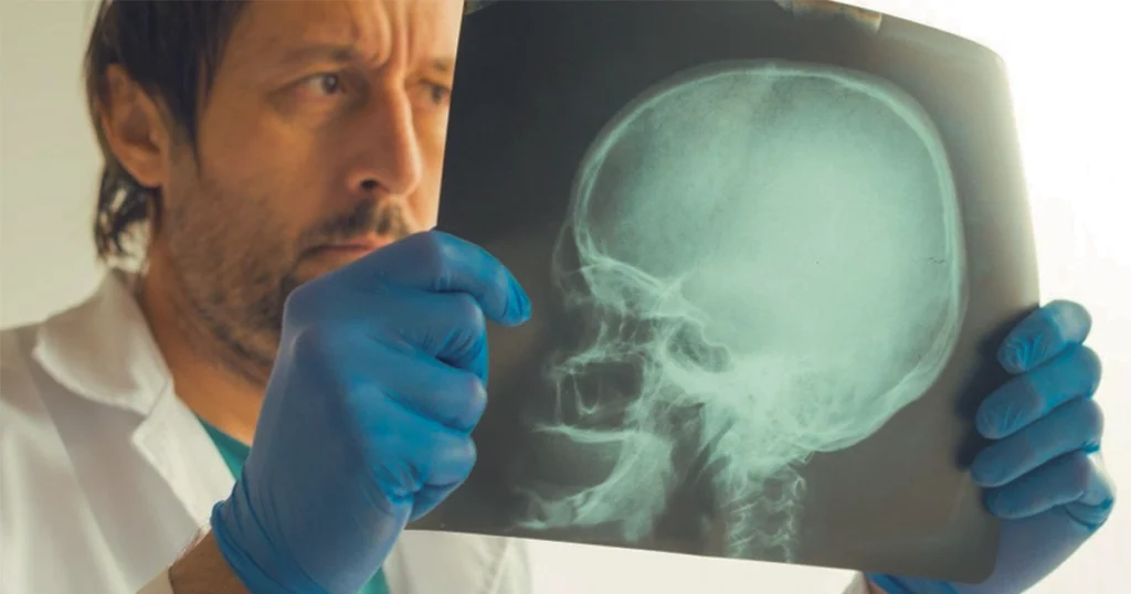 Doctor reviewing skull X-ray for severe fracture diagnosis